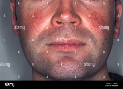 Telangiectasia Face