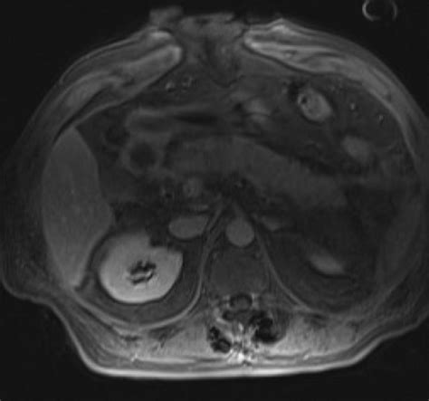 T1 Weighted Fat Suppressed Contrast Enhanced Axial Mri Pancreatic