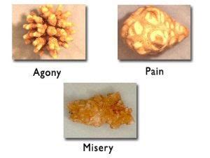 How long does detox take? How Long Does It Take To Pass Kidney Stones After Blasting ...