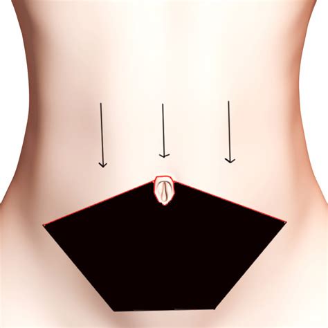 La plastie abdominale meilleure chirurgie esthétique du ventre relâché. Abdominoplastie à Bordeaux par le Dr Réau chirurgien ...