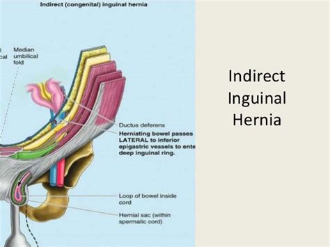 Laparoscopic Inguinal Hernia Repair Tapp