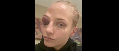 Boxer Ebanie Bridges Suffers Terrible Swollen Eye After Losing To