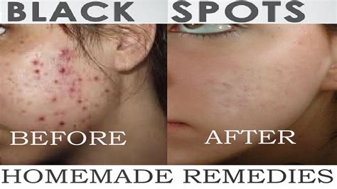Pin On How To Get Rid Of Acne Scars Overnight Home Ingredients