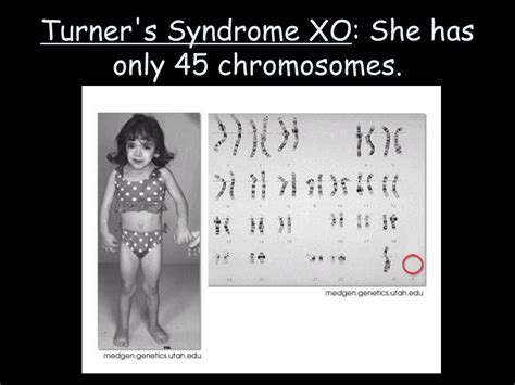 Ts Moles Turner Syndrome Chromosomal Disorders Syndrome My XXX Hot Girl