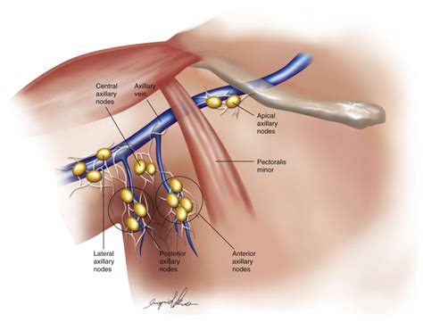 Whenever the lymph nodes become inflamed, a biopsy can be performed. Microsurgical Procedures: Vascularized Lymph Node Transfer ...