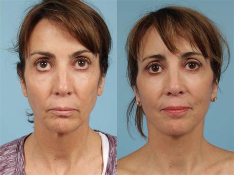 Neck Lift Before And After Photos Patient 257 Chicago Il Tlkm