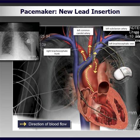 Pacemaker New Lead Insertion Trialexhibits Inc