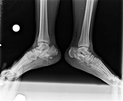 Calcaneus Fractures Trauma Orthobullets