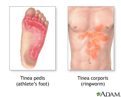 Ringworm And Athlete S Foot Symptoms And Treatments
