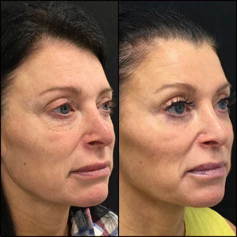 upper and lower blepharoplasty with fat transfer before and after photos flora levin md