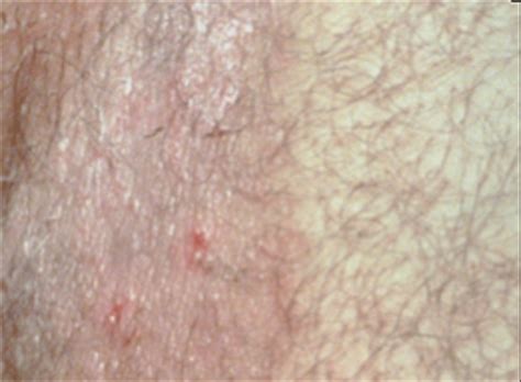 Ringworm