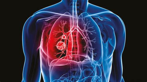 Cancer cells can spread to other parts of the body through the blood and lymph systems. Smoking and lung cancer - Roy Castle Lung Cancer Foundation