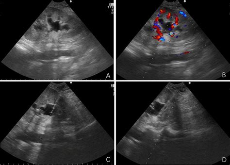 Method Of Ultrasound Guided Percutaneous Nephrostomy A Gray Scale