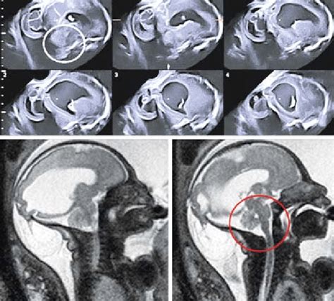 Tomographic Ultrasound Imaging Tui And Mri Of The Brain In A Case Of