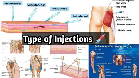Types of Injection इजकशन क परकर IM IV Subcutaneous