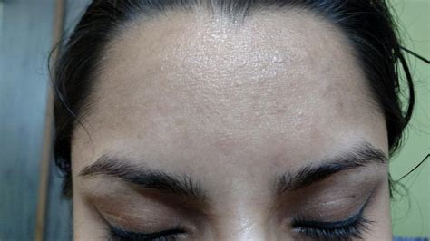 Please Help Me With What This Is Rough Forehead Skin Adult Acne