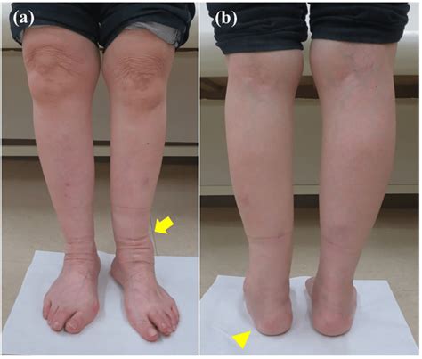 Standing Clinical Photographs Showing A Valgus Deformity Of The Left