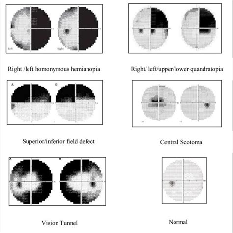Pdf Classification Of Multiple Visual Field Defects Using Deep Learning