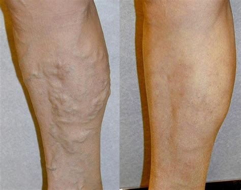 Before And After San Diego Skin And Vein Laser Clinic