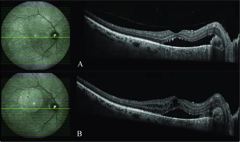 Optical Coherence Tomography Images A At Initial Visit A Choroidal Download Scientific