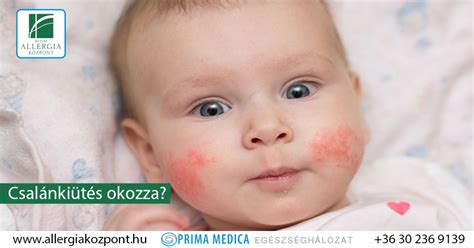 Mi okozza, és hogyan diagnosztizálható? Csalánkiütés gyerekeknél - ezekre figyeljünk kivizsgálás előtt