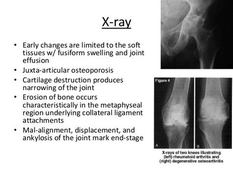 Please refer to the related articles for a general discussion of rheumatoid arthritis. x ray rheumatoid arthritis vs osteoarthritis - Google ...