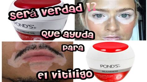 Crema Rejuveness Sirve Para El Vitiligo Te Pigmenta La Piel 😱 Youtube