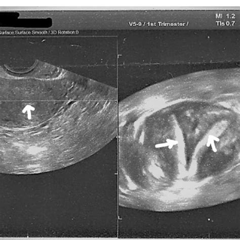 Illustration Of Uterus Didelphys In Our Clinical Case The Arrows Are