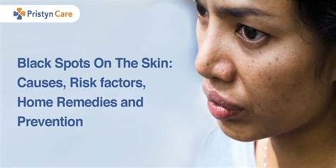 Black Spots On The Skin Causes Risk Factors Home Remedies And Prevention
