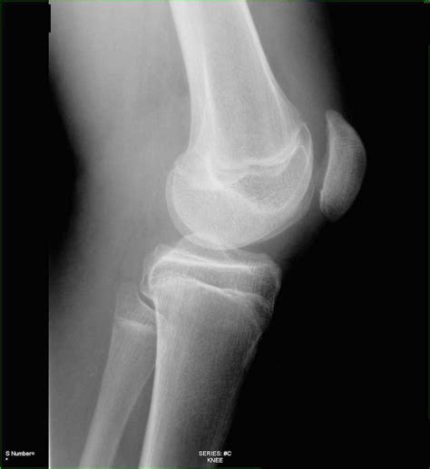 Fracture Of Patella On X Ray X Rays Case Studies Ctisus Ct Scanning
