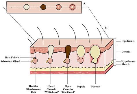 What Is Acne And What Causes It · Frontiers For Young Minds