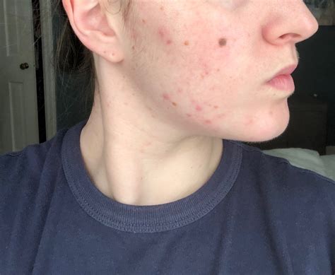 My Tretinoin Journey How I Finally Cured My Hormonal Acne