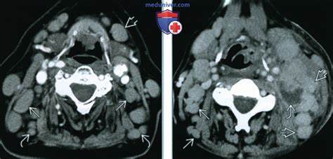 Диета при лимфоме неходжкинской желудка КТ, МРТ при неходжкинской лимфоме лимфоузлов добавочной цепи КТ, МРТ при неходжкинской лимфоме лимфоузлов добавочной цепи Диета при лимфоме неходжкинской желудка