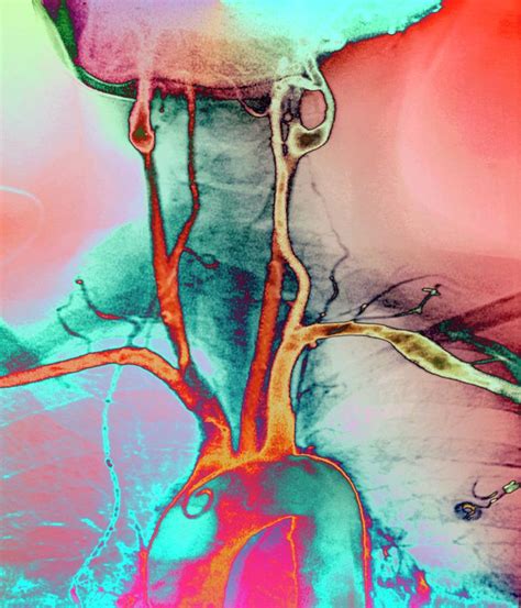 One on the position of the branched carotid arteries is where a person can feel the pulse in their neck. Chest And Neck Arteries Photograph by Zephyr/science Photo Library