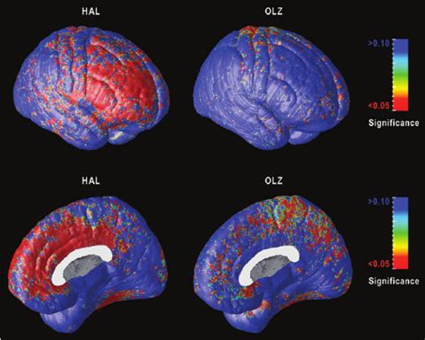 Progressive Gray Matter Loss After 1 Year Statistical Maps Show The