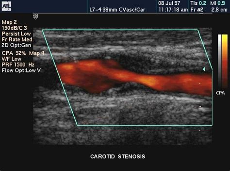 Power Doppler Imaging Of Carotid Artery Stenosis Stroke My XXX Hot Girl