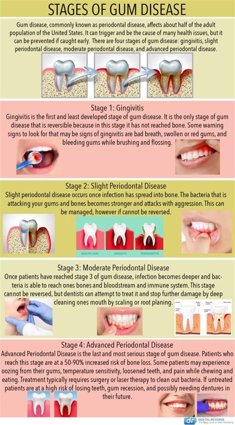 Bleeding Gums Philadelphia Pa Gum Disease Gingivitis