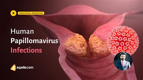 Human Papillomavirus Infections Medicine Lectures Student Education