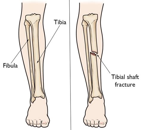 Tibia Shinbone Shaft Fractures Orthoinfo Aaos