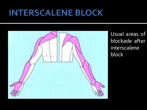 Interscalene And Supraclavicular Nerve Blocks