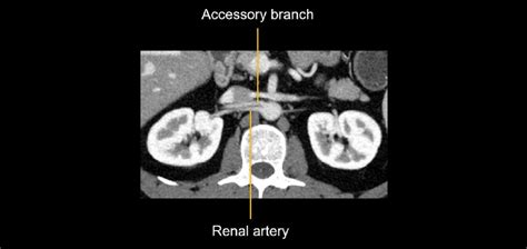 Abdominal Ct Abdominal Arteries Litfl Radiology Library