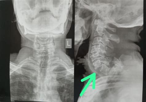X Ray Cervical Spine Ap And Lateral View Green Arrow Showing Fracture