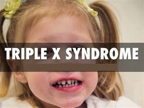 Síndrome De Triplo X