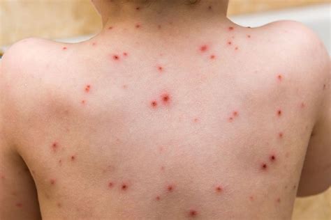 Preventing And Treating Chicken Pox Scars Tips And Remedies