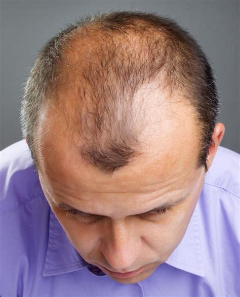 What Are The Different Hairstyles For Thinning Hair