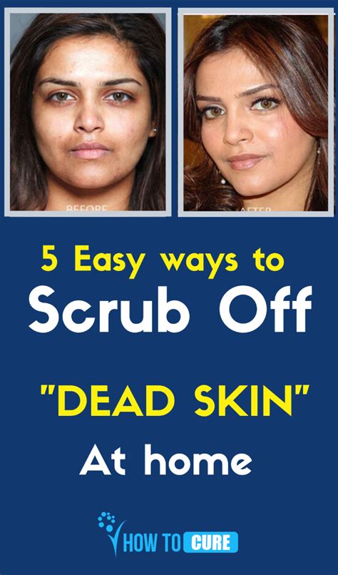 How To Get Rid Of Dead Skin In 5 Natural Ways Dead Skin Removal Dead
