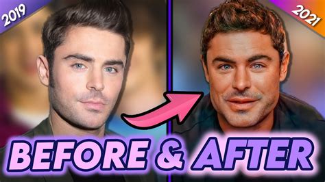 Zac Efron | Before & After | Why He REALLY Got Plastic Surgery? - YouTube