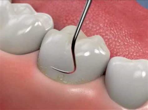 Teeth stains can be cleaned with something as simple as a toothbrush or baking soda, peroxide and teeth whiteners. Deep Cleaning Teeth, After Care, does it Hurt, Home ...