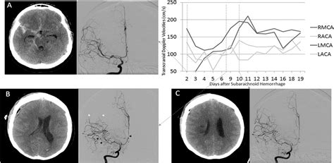 The Pathophysiology Of Delayed Cerebral Ischemia Journal Of Clinical