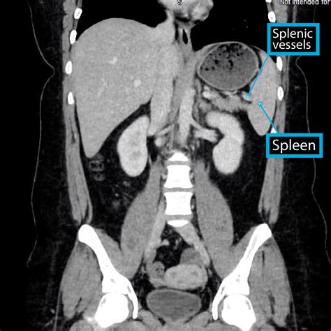 Gross Anatomy Glossary Spleen Imaging Ditki Medical And Biological